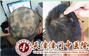黑龙江省青年医学会附属医院治疗脱发