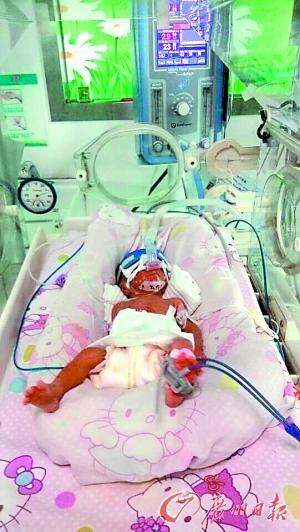 双胞胎早产离不开呼吸机 父母发愁20余万医药费