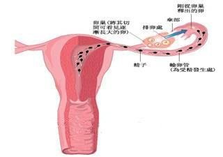 输卵管阻塞