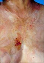 专家解说牛皮癣症状特点有哪些