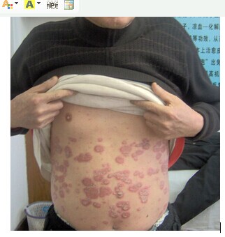 牛皮癣治疗怎么办，重庆哪家治疗好