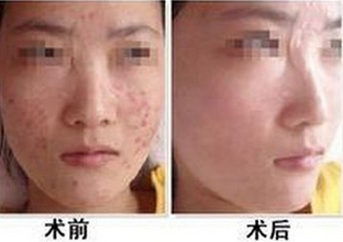 脸上痘痘给影响扣分