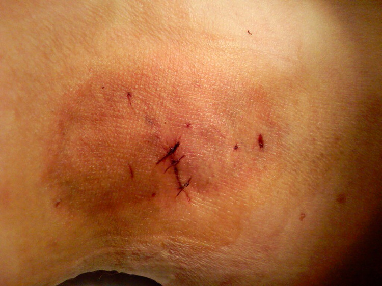 狐臭的危害你知道吗