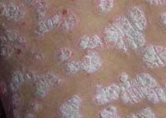 重庆牛皮癣哪里医治较好
