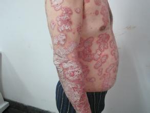 重庆牛皮癣哪里医治比较好