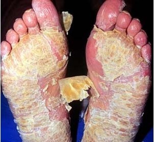 重庆治牛皮癣病医院哪家好