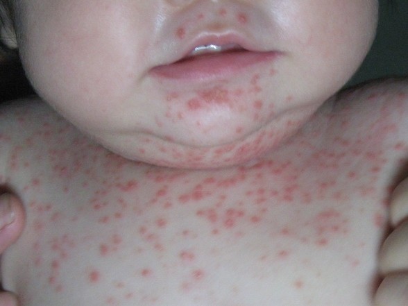 重庆治牛皮癣病好的医院