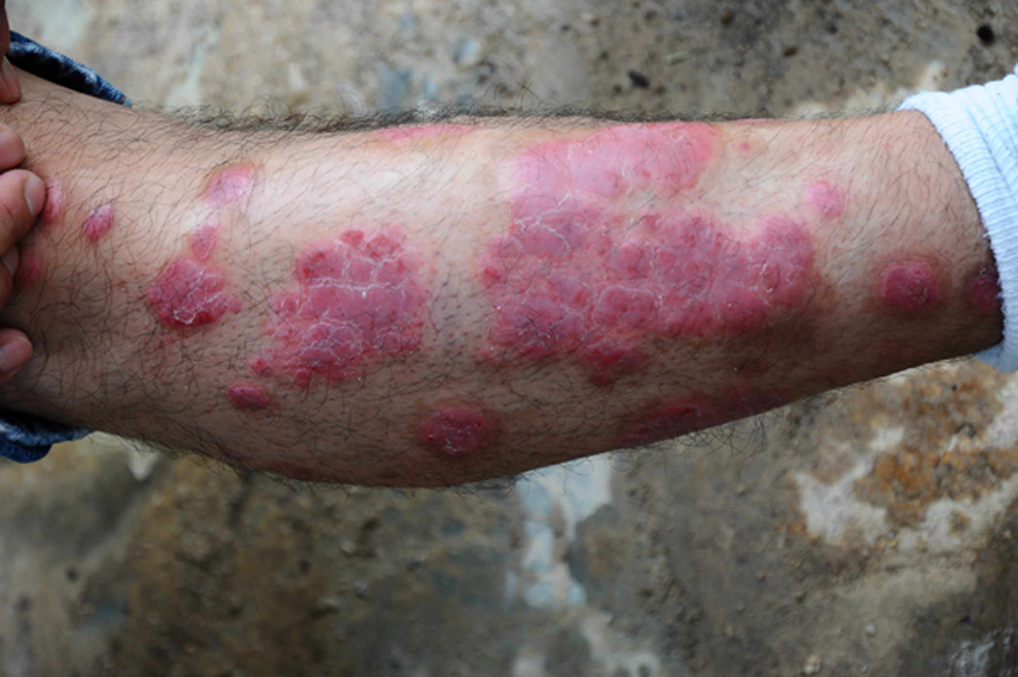 重庆哪里治疗牛皮癣非常好