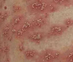 重庆哪里诊治牛皮癣比较好