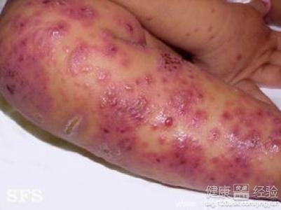 皮炎湿疹怎么会传染呢！