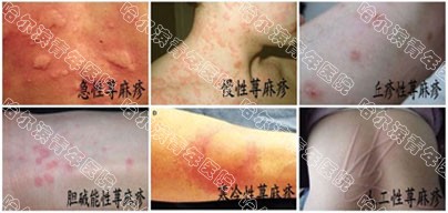 荨麻疹症状
