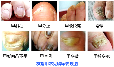灰指甲的症状图