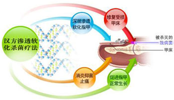 灰指甲治疗