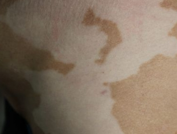 重庆朝天门医院解读白癜风小常识