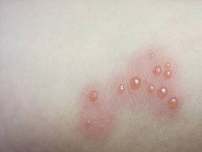 疥疮的治疗方法