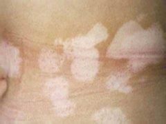 引起白癜风的4点因素