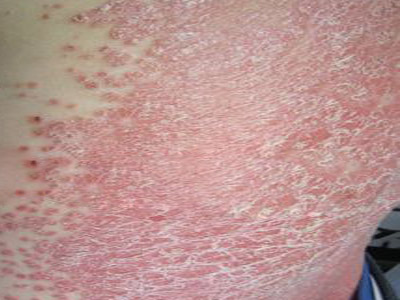 如何才能减缓牛皮癣的病症