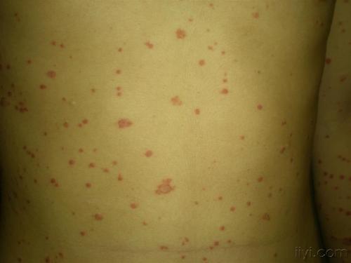 牛皮癣的发病时期