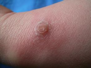 寻常疣对患者的危害有哪些？