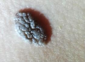 得了寻常疣的症状是什么