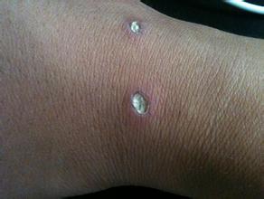 寻常疣的饮食护理要注意什么