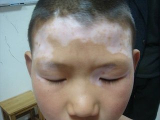 重庆治疗白斑需要多少钱