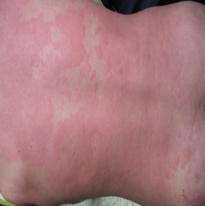 荨麻疹的发作与哪些原因颇有渊源呢