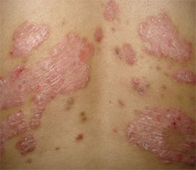 孕妇得了牛皮癣之后会不会遗传给宝宝