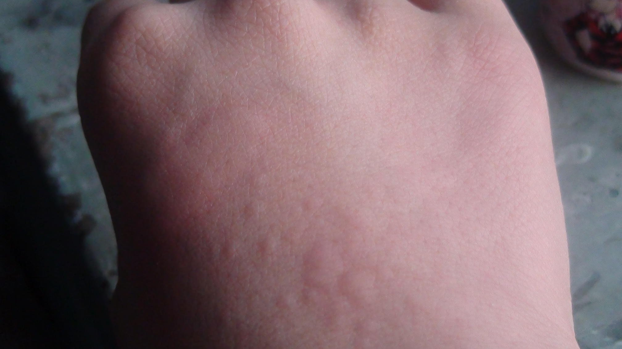 在怀孕的时候得了荨麻疹怎么办