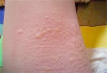 荨麻疹图片 荨麻疹图片