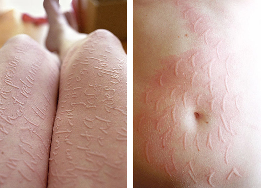 荨麻疹图片 荨麻疹图片