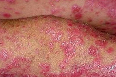 红皮型牛皮癣的症状有哪些
