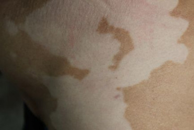 早期的白癜风能不能治好