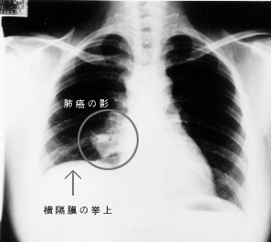 肺癌竟当咳嗽治！25岁女孩不幸身亡 | 这16个癌症信号一定要知道！ 