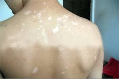 背部白癜风好治吗