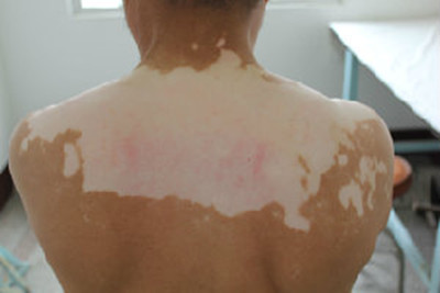 治疗白癜风需注意哪些事项