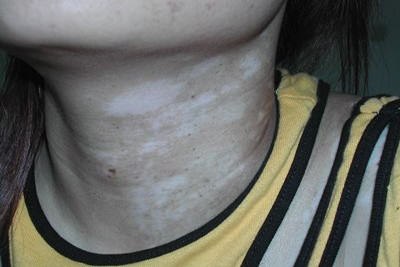 白癜风的日常保健常识有哪些