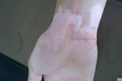 使青少年发生白癜风的原因是什么