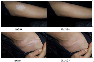 患上白癜风饮食上应该注意些什么