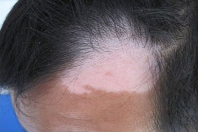 白癜风应该怎样治疗