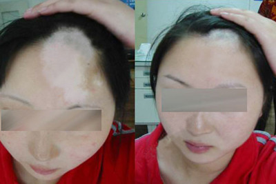 女性白癜风病情为什么会加重