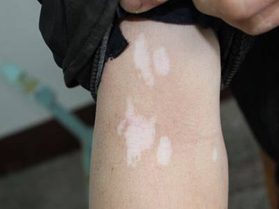 白癜风和白色胎记怎么区分