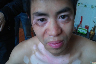 白癜风病情轻重怎么判断