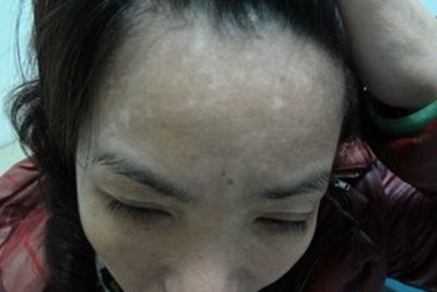 面部白癜风的发病原因有哪些