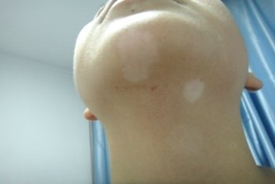 白癜风都有哪些症状
